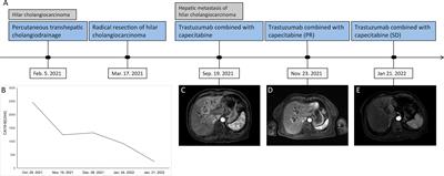 Effectiveness of Trastuzumab Combined With Capecitabine Treatment in a Patient With Hilar Cholangiocarcinoma Complicated by Liver Metastases With an ERBB2-Activating Mutation: A Case Report